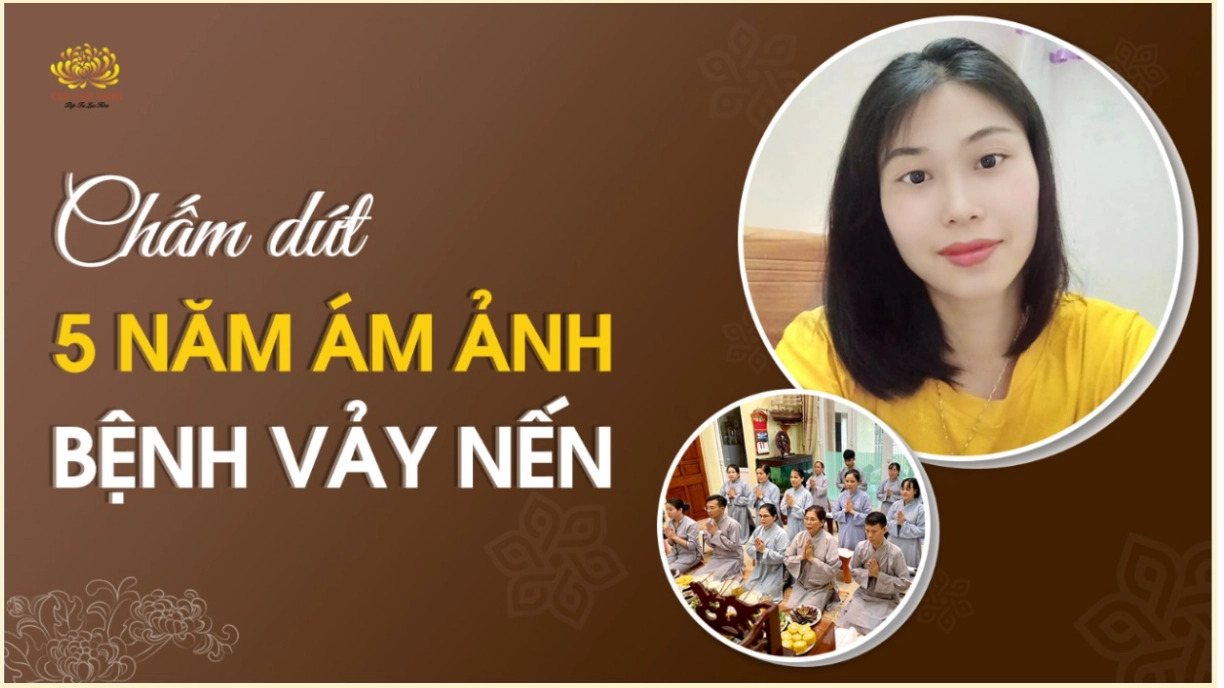 Bệnh vảy nến 5 năm chuyển hóa nhanh chóng nhờ điều này